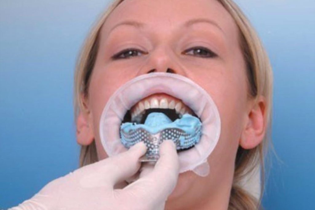 Dental molds in mouth of patient at practice